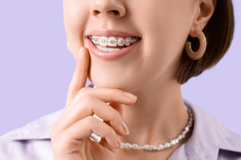 Por Que o Aparelho Fixo Metálico Continua Sendo o Mais Utilizado