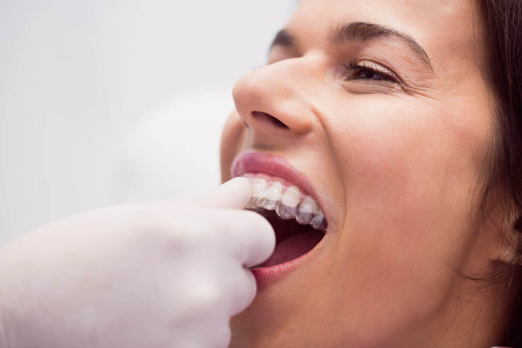 Close de paciente mulher sorridente encaixando um alinhador transparente nos dentes superiores com os dedos. Mostra detalhes do aparelho na Clínica Odontológica R7 Implantes.