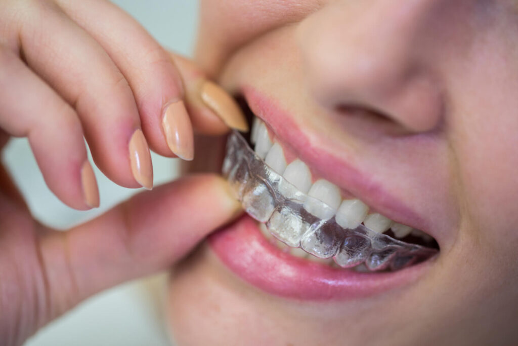 Close de dentes superiores com alinhador transparente Invisalign sendo encaixado com os dedos na Clínica R7 no Catete, Rio de Janeiro.